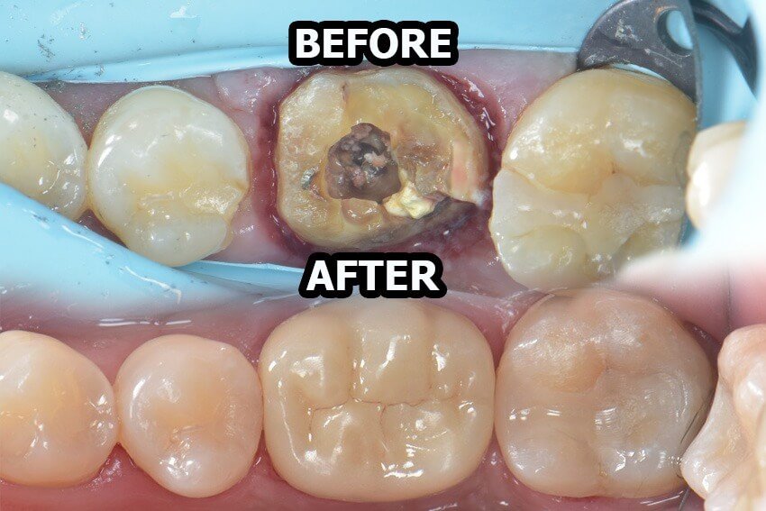 Before dan after perawatan gigi di Dental 21 PIK