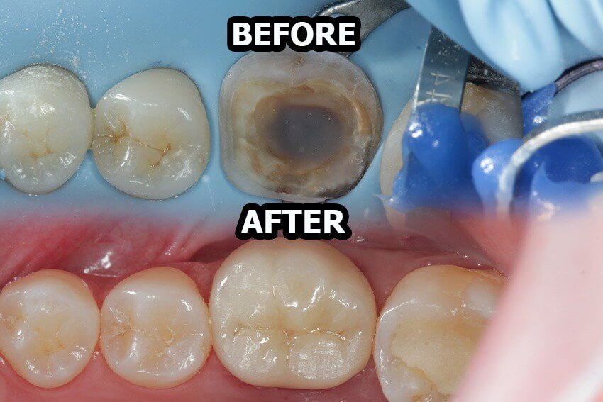 Before dan after perawatan gigi di Dental 21 PIK