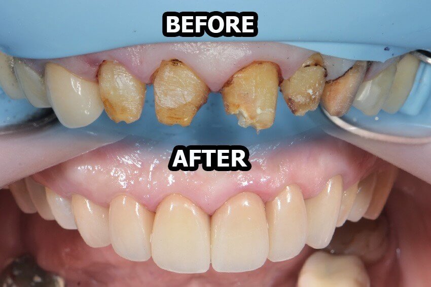 Before dan after perawatan gigi di Dental 21 PIK