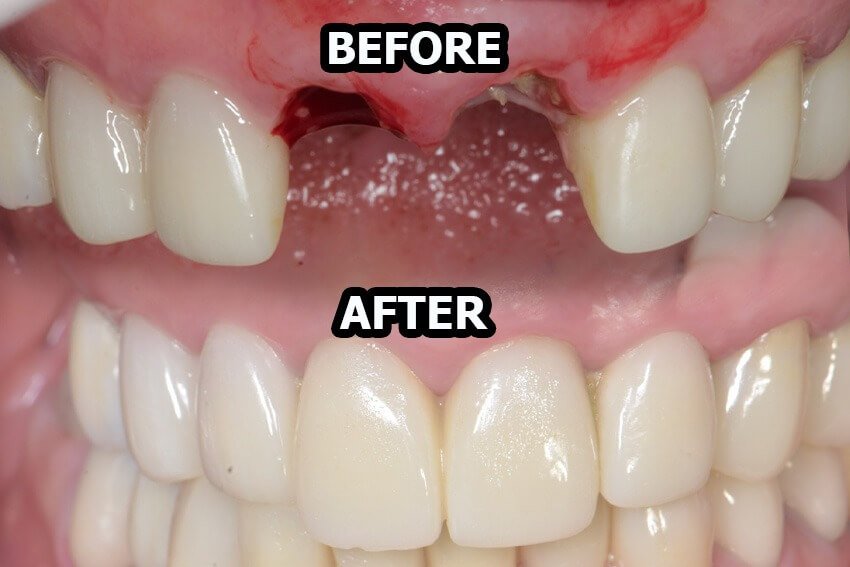 Before dan after perawatan gigi di Dental 21 PIK