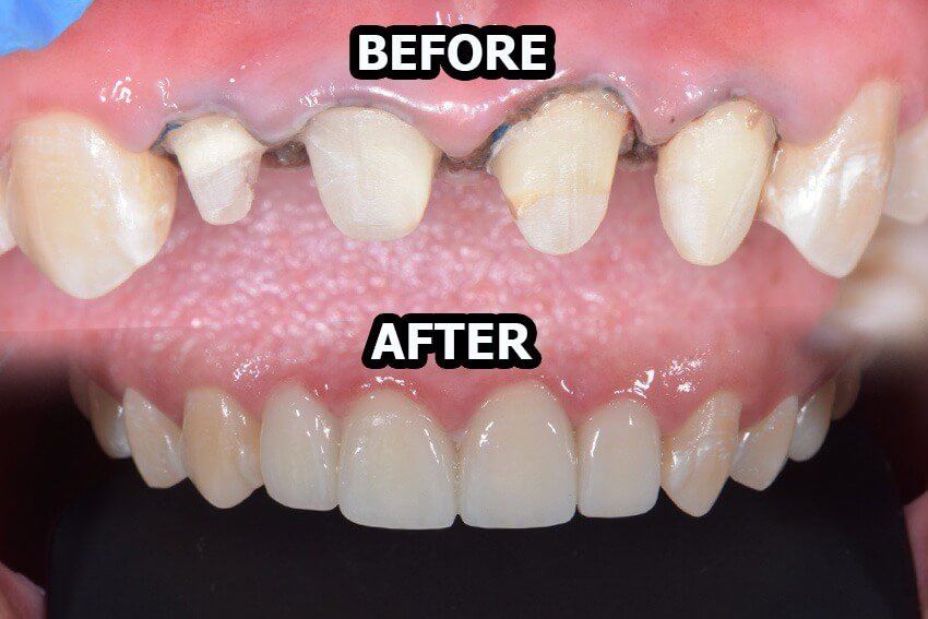 Before dan after perawatan gigi di Dental 21 PIK