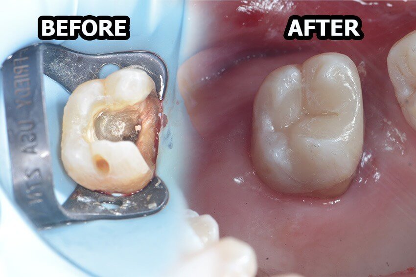 Before dan after perawatan gigi di Dental 21 PIK