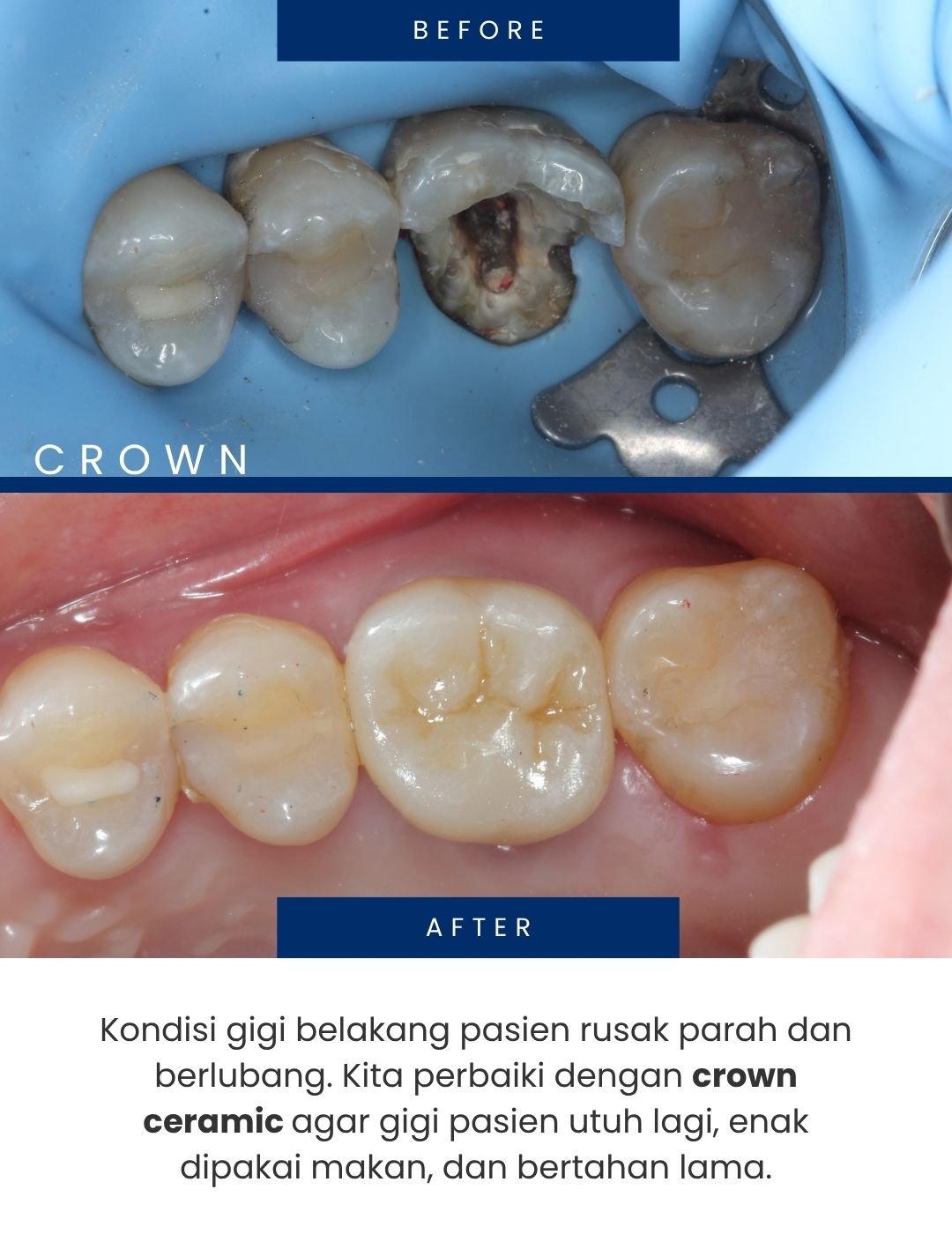 Pasien datang dengan gigi depan patah dan berlubang besar. Kita perbaiki dengan veneer ceramic untuk hasil yang natural. (1080 x 1350 px) (2)