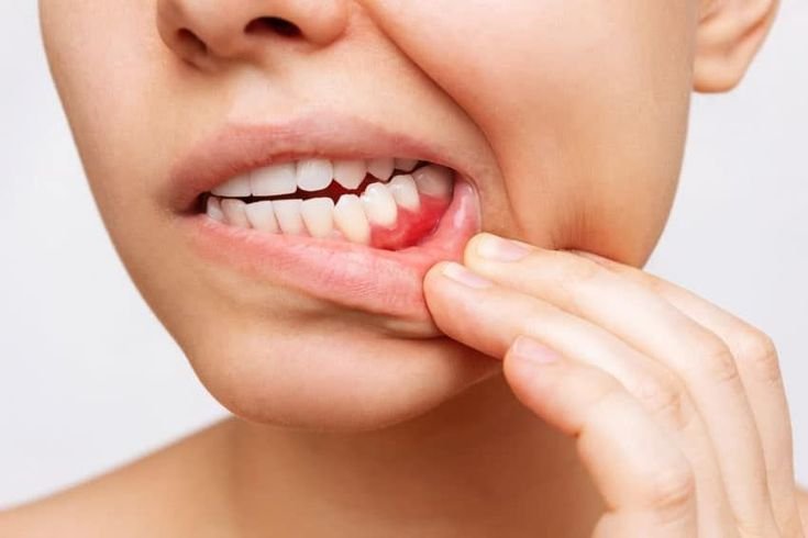 What Is A Periodontal Disease_