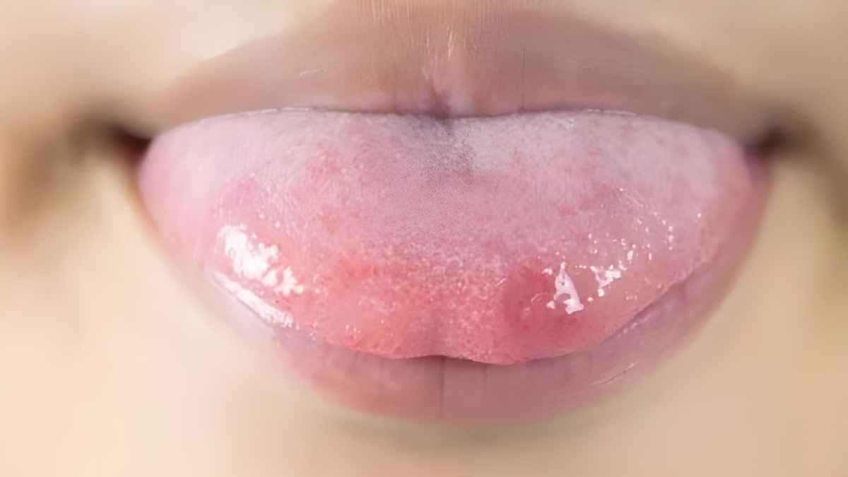 Perawatan Untuk Mengatasi Sariawan di Lidah