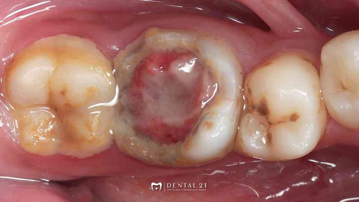 Daging keluar dari gigi