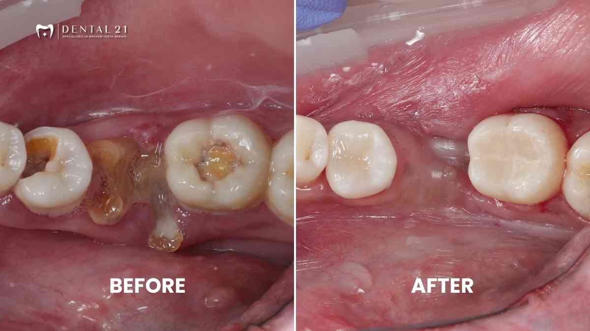 Before After Hasil Perawatan, Cabut gigi dan Tambal gigi