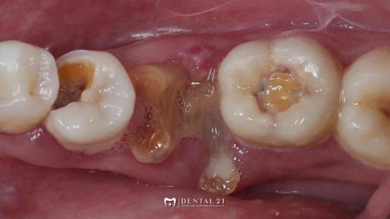 Gigi Berlubang Parah: Masih Bisa Diselamatkan atau Harus Dicabut?