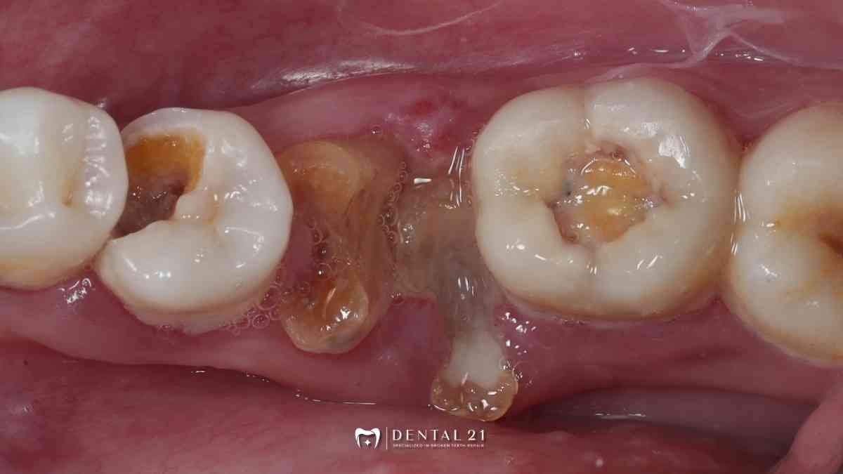Gigi Berlubang Parah: Masih Bisa Diselamatkan atau Harus Dicabut?