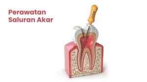perawatan saluran akar