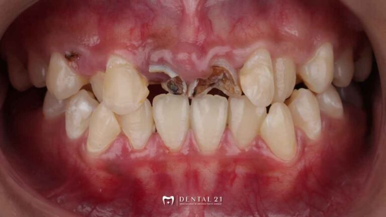 Dentist PIK gigi rusak parah