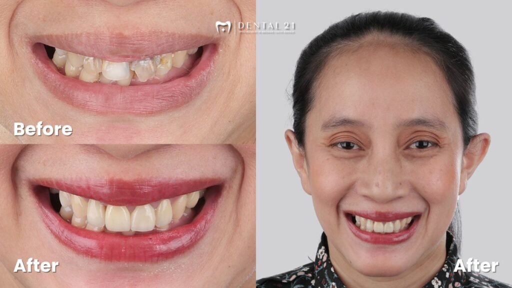 Before After Crown Veneer Dental 21 