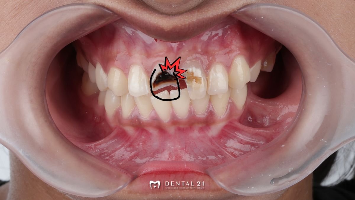 Gigi Atas & Bawah Tabrakan