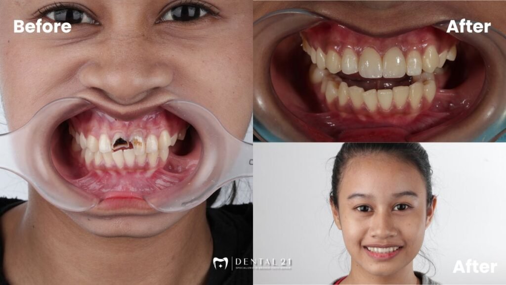 Hasil Akhir Senyum Natural dan Fungsional