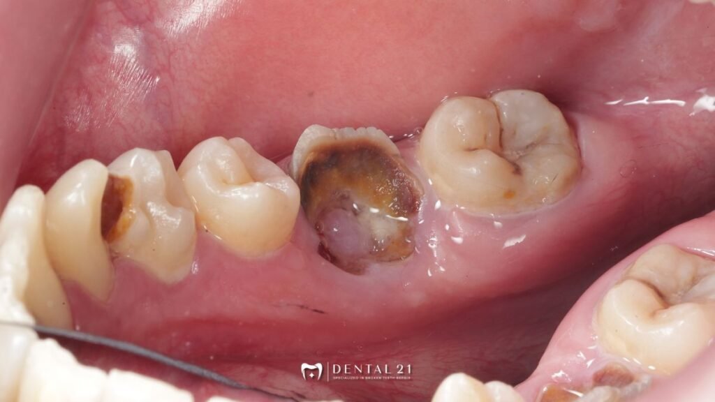 Ketahui Penyebab Gigi Berlubang