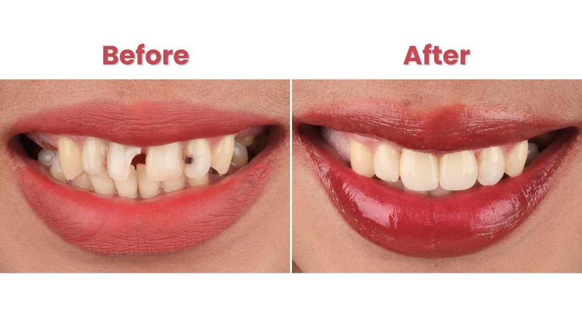 Before After Restorasi Gigi