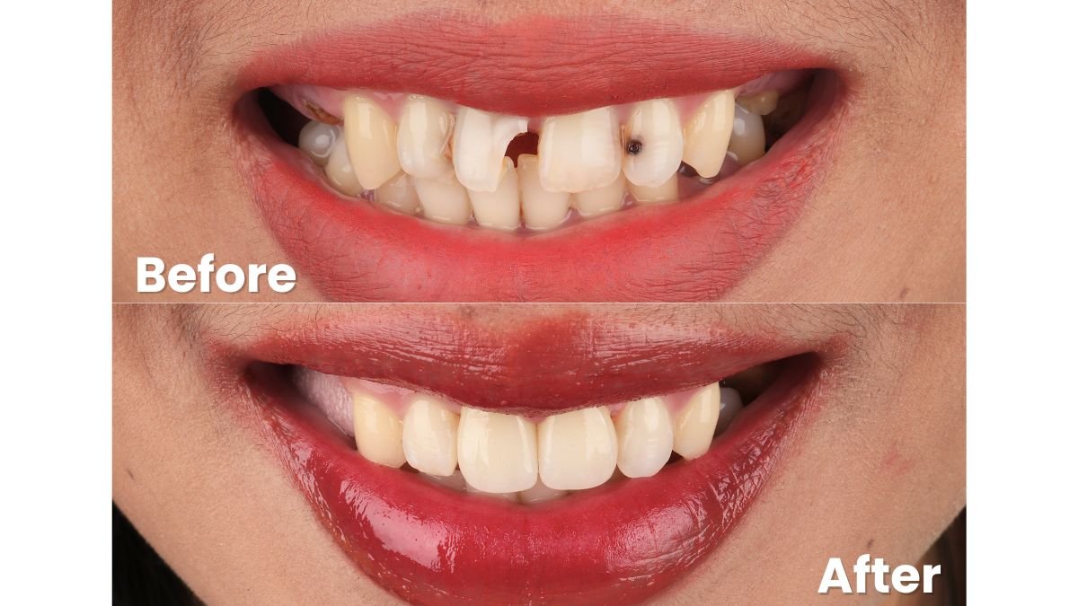 Restorasi Gigi Adalah