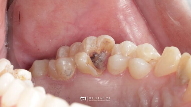 Sakit Gigi Berlubang