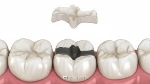 Inlay dan Onlay Gigi