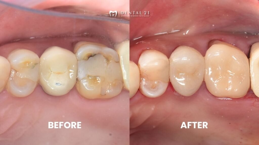 Before After Crown & Onlay