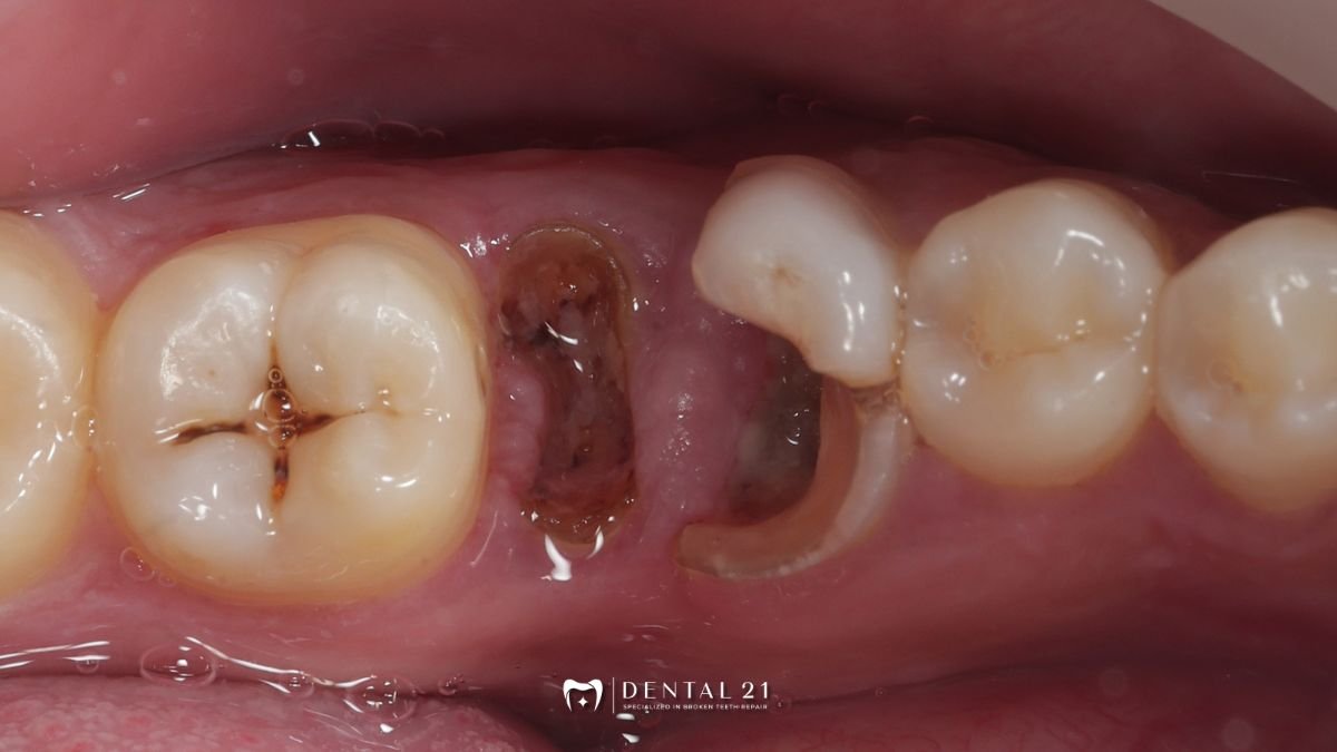 Solusi Gigi Terbelah Dua