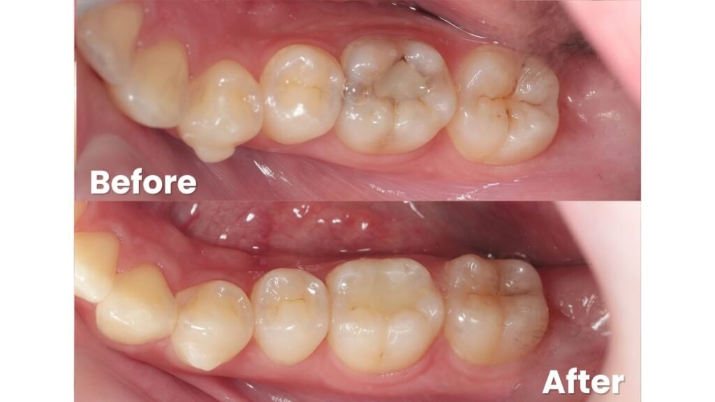 Tambal gigi darurat di PIK