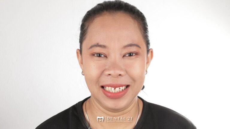 Malu Senyum karena Gigi Berlubang