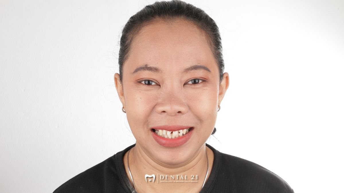 Malu Senyum karena Gigi Berlubang