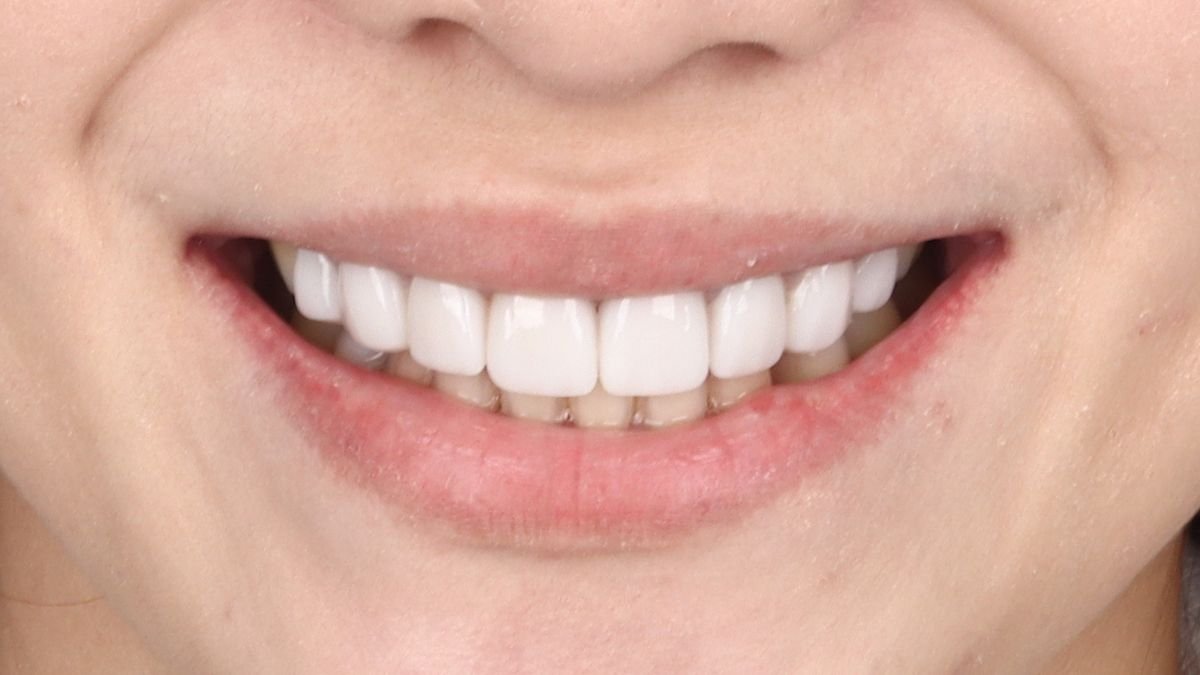 Veneer gigi natural