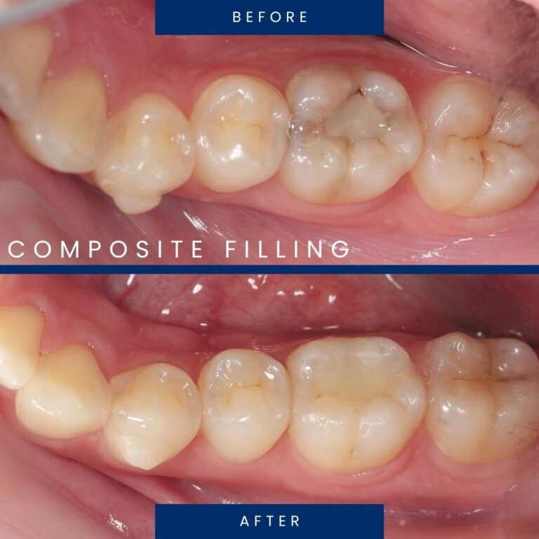 before after tambalan komposit