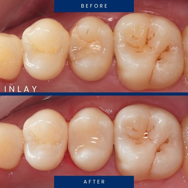 before after inlay