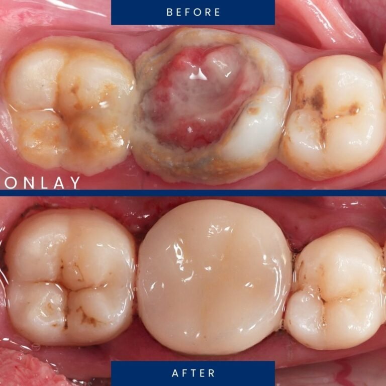 before after onlay