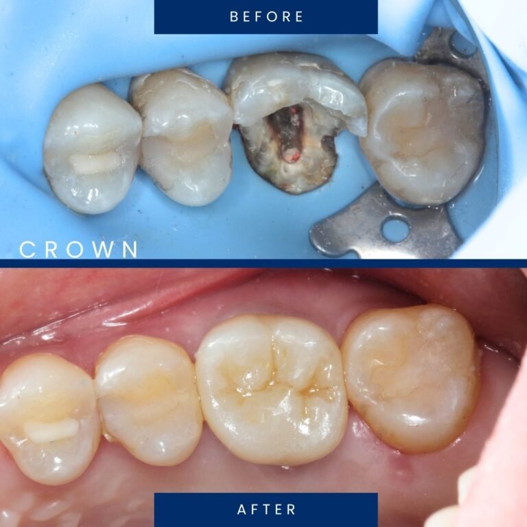 before after crown