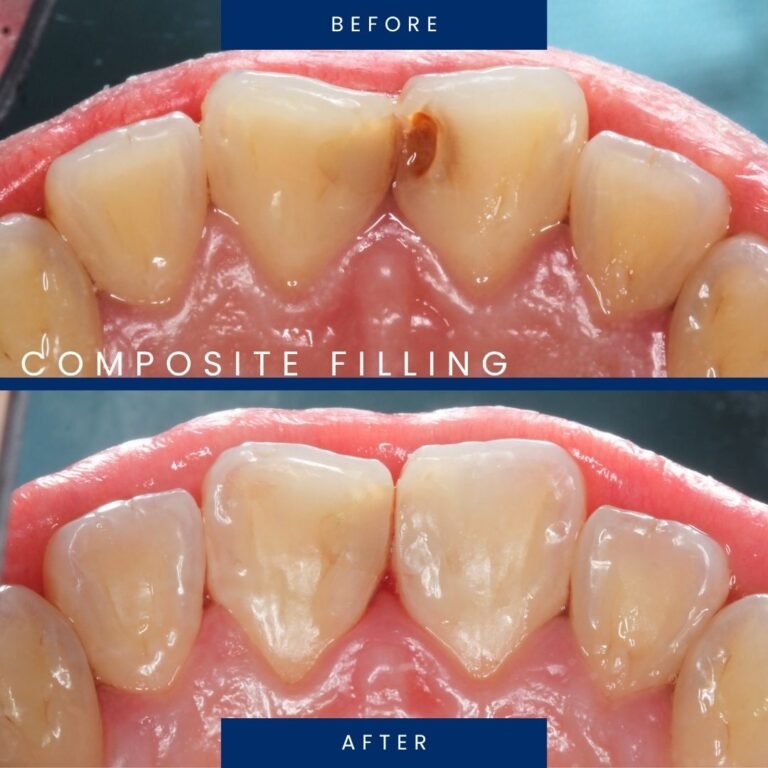 before after tambalan komposit 2