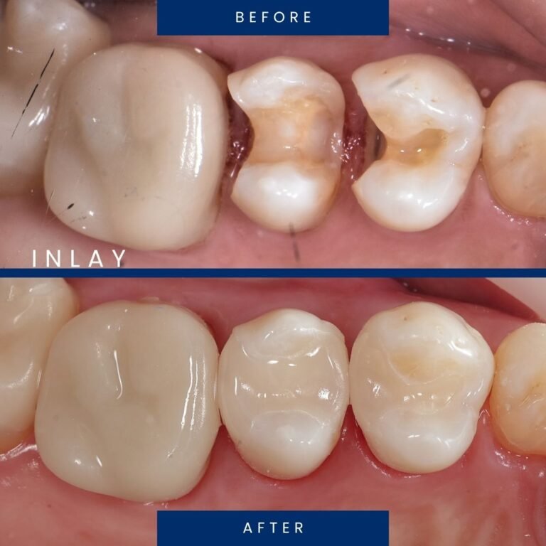 before after inlay 2