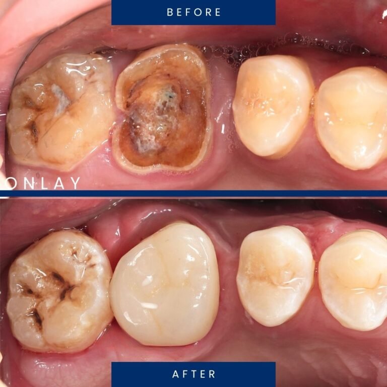 before after onlay 2
