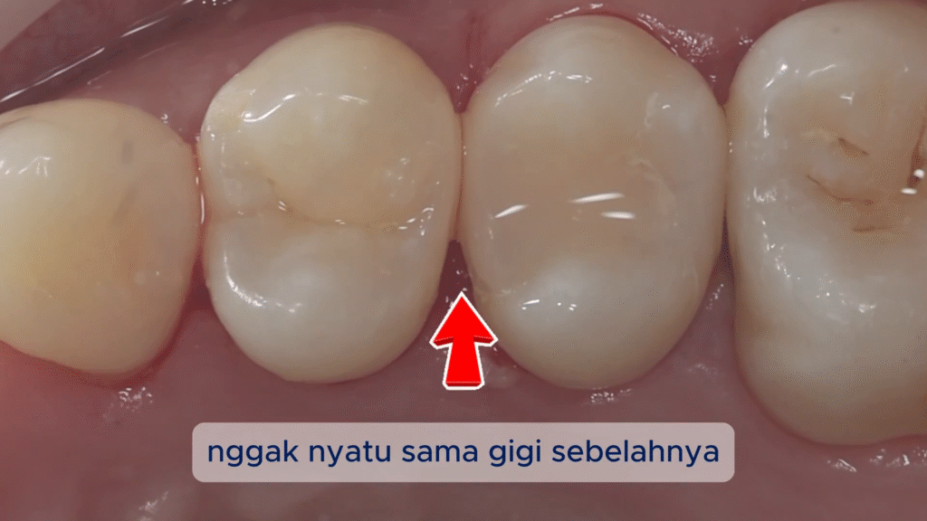 Hasil Akhir yang Estetis & Rapat