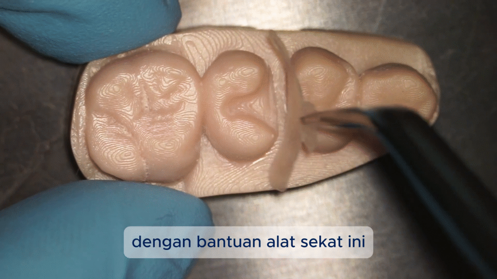 Keterbatasan Tambal Biasa