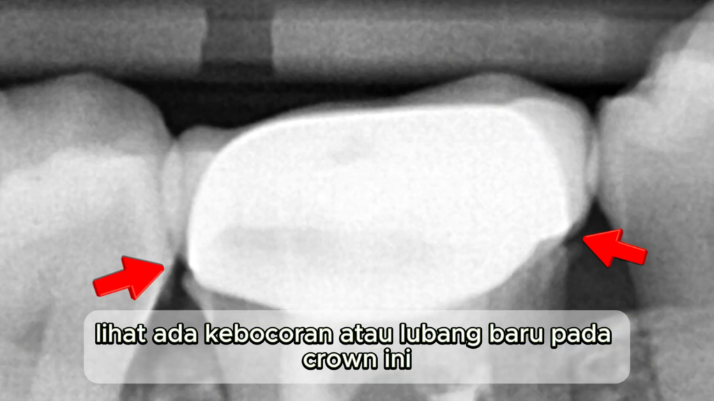 Hasil pemeriksaan X-Ray di Dental 21