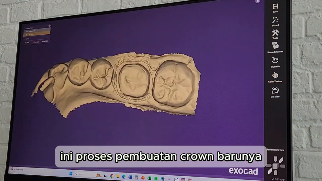 Proses desain crown baru menggunakan perangkat lunak CAD 3D
