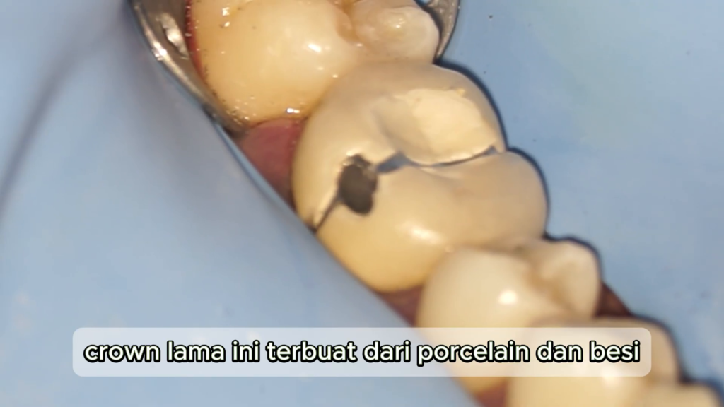 crown lama berbahan porcelain dan besi