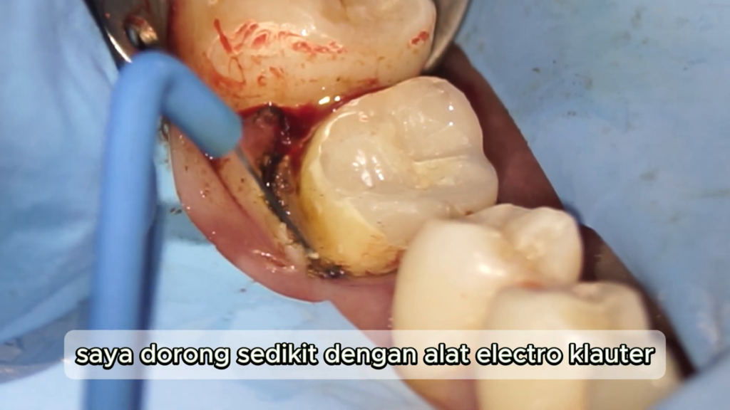electrocauter dan benang retraksi