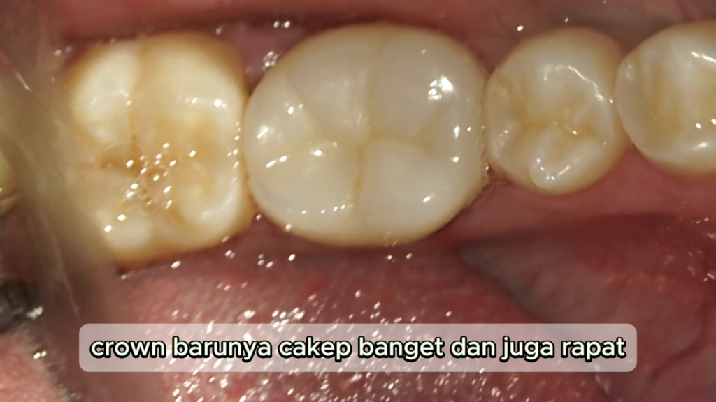 pemasangan crown baru